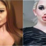 Девушка из Болгарии с самыми большими в мире губами провела 20-ю процедуру по их увеличению