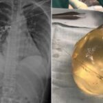 Счастливый случай спасения жизни силиконовыми имплантатами